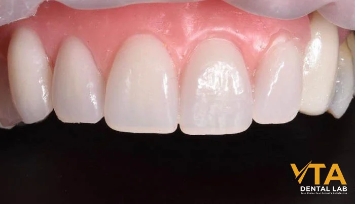 Side-by-side comparison of porcelain denture vs acrylic denture teeth materials