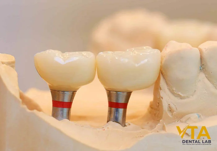 Types of dental crowns include zirconia, porcelain-fused-to-metal (PFM), gold, and all-ceramic restorations
