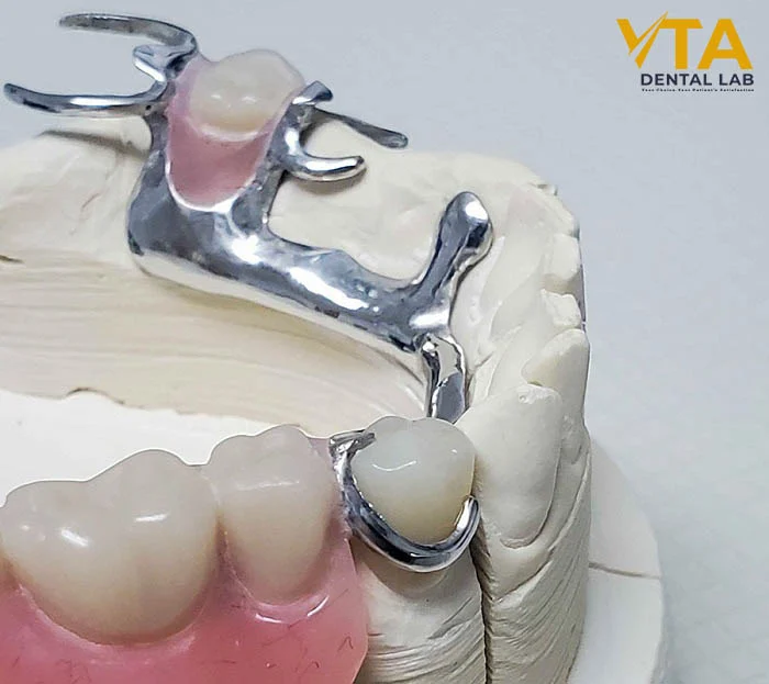 High-quality porcelain partial denture with metal framework for extra durability
