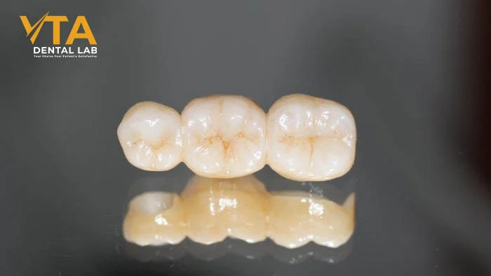 5 Types of Dental Crowns 