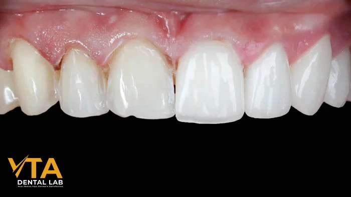 Comparison of natural teeth before and after veneer preparation