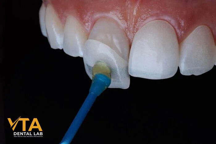 Minimal veneer preparation showing conservative enamel reduction