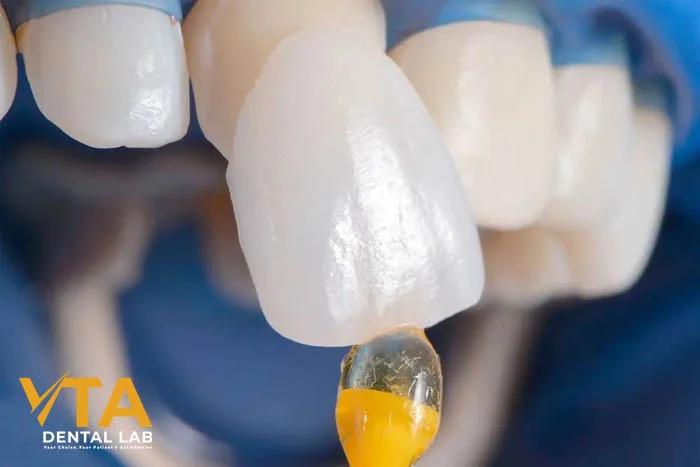 Technician placing a retraction cord on model for veneer preparation planning