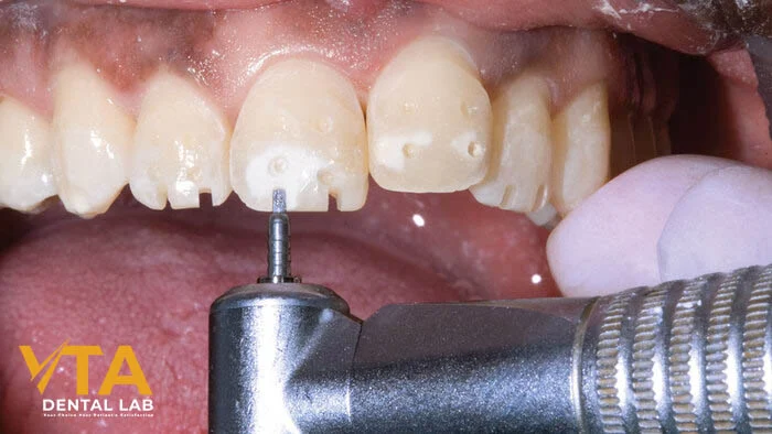 Step-by-step guide showing veneer preparation on anterior teeth