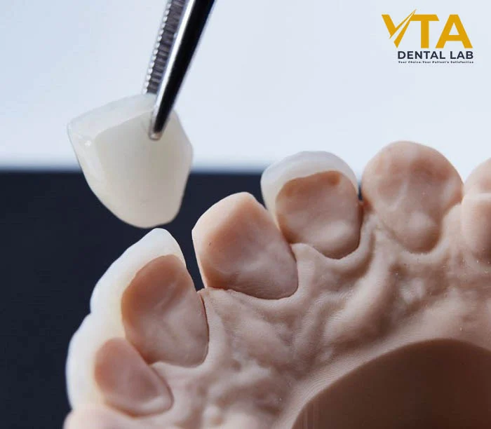 Emax veneers combine translucency and strength for a long-lasting, natural look