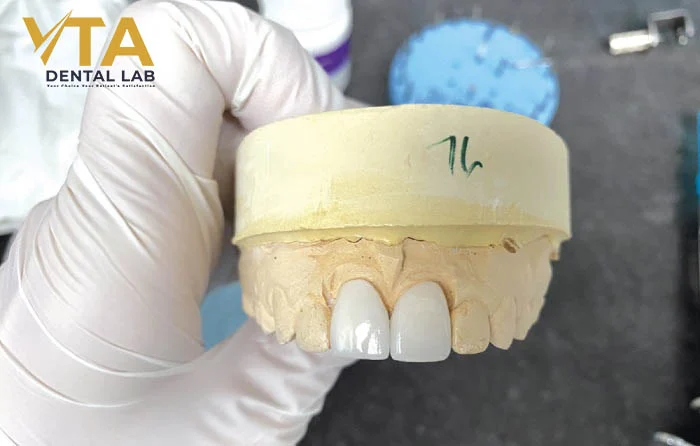 E.max veneers offer superior colour stability and perfect fit