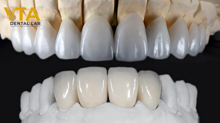 E.max Veneers vs Porcelain Veneers: A Clinical Perspective for Dentists