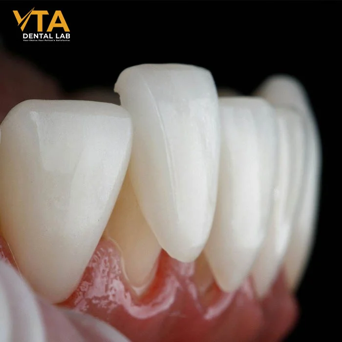Close-up of porcelain veneer edges showing natural layering