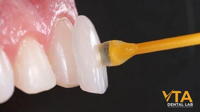 Dentist placing E.max veneers on patient’s upper front teeth
