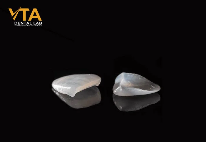 E.max veneer shells showing natural translucency and thin profile