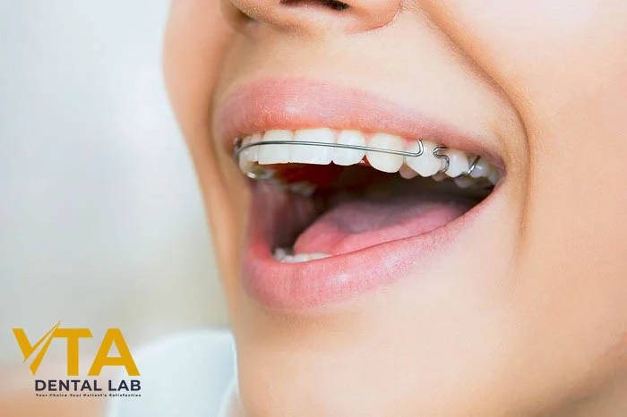 High-quality Hawley retainer with smooth acrylic surface for comfortable daily wear