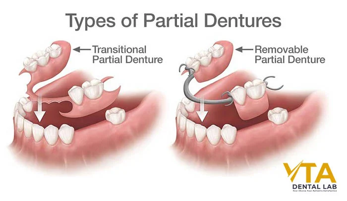 Types of Partial Dentures