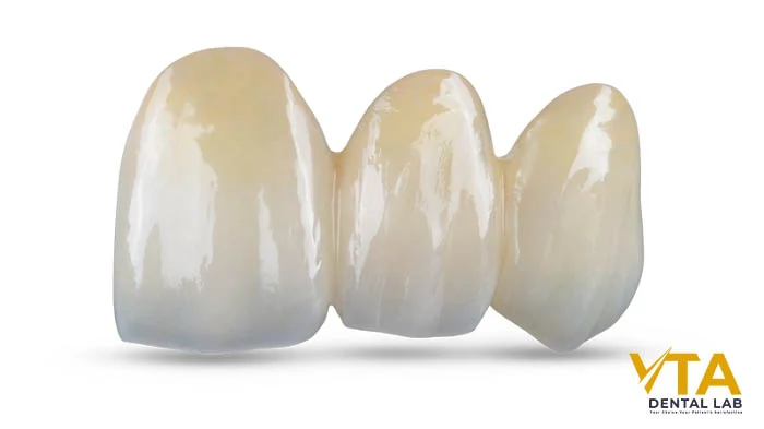 A dental bridge consisting of multiple connected crowns designed to replace missing teeth and restore function