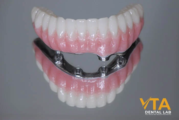 Dental implants are the most popular alternative to removable dentures