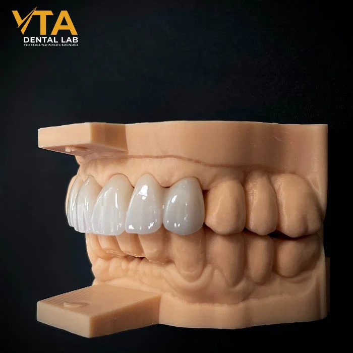 Anterior zirconia crowns made from Cercon® ht ML, delivering lifelike esthetics and soft light diffusion.