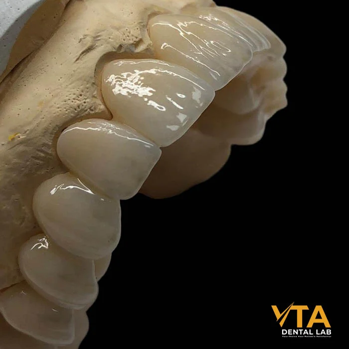 Finished Cercon® ht ML restorations after sintering and staining, achieving natural esthetics without porcelain layering